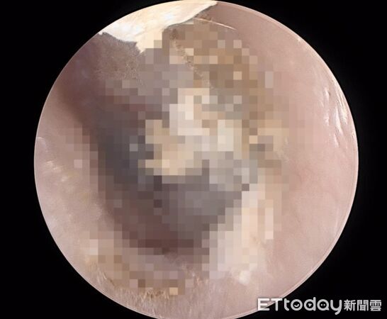 他瘋越式洗頭！2週後癢到爆　「通通都黴菌」醫一看傻了