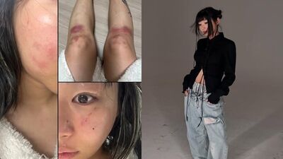 全身傷痕累累！韓女星控前男友軟禁掐頸　淚訴：公開才能結束