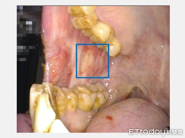 ▲郭曉芮醫師指出，頭頸癌重建關鍵在於讓病人能恢復社交與自理能力。（圖／記者游瓊華翻攝）