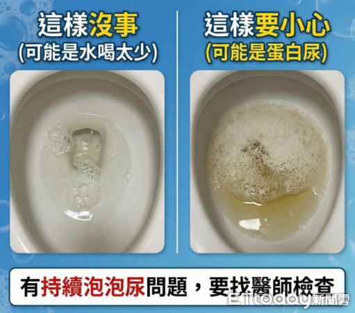 ▲▼      蛋白尿       。（圖／翻攝蘇信豪醫師臉書）