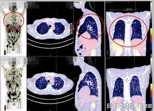 ▲▼      免疫療法       。（圖／雙和醫院提供）