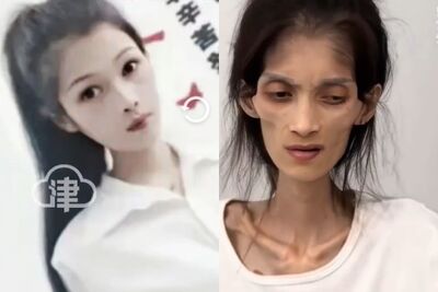體重剩17kg!27歲陸女因「胃萎縮過世」 她生前喊話:想活下去