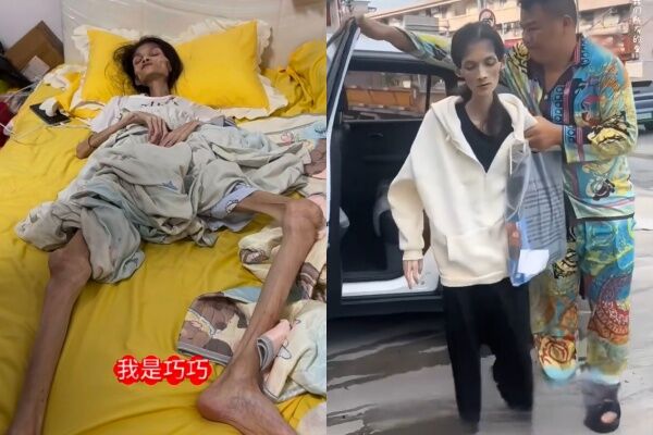 ▲巧巧體重僅剩17kg。（圖／翻攝自微博）