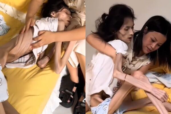 ▲▼體重剩17kg，27歲巧巧因胃萎縮過世。（圖／翻攝自微博）