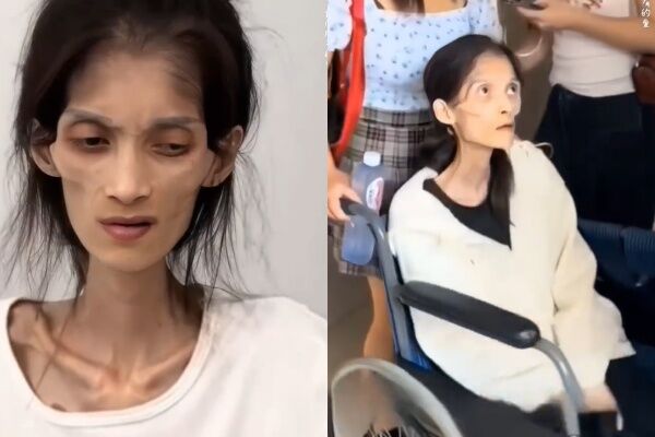 ▲▼體重剩17kg，27歲巧巧因胃萎縮過世。（圖／翻攝自微博）