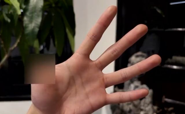 ▲▼  男子被自己養的五步蛇咬截肢           。（圖／翻攝 網易）