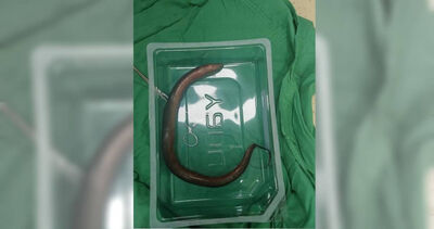 30cm鱔魚在「腹腔裡游著」！30歲男臉色慘白衝急診喊：救救我