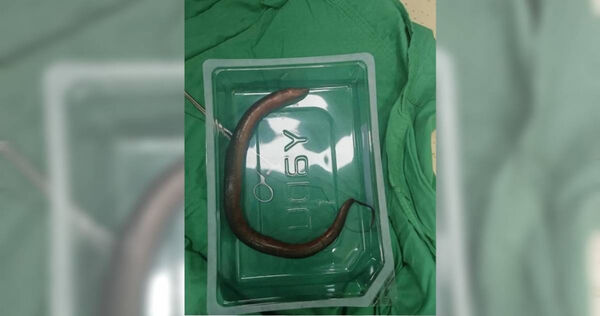 湖南一名男子到急診求救，醫師檢查發現他腹腔內竟有30公分長的鱔魚。（圖／翻攝自微博／瀟湘晨報）