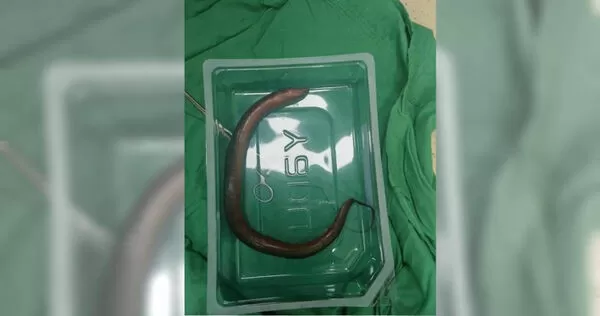 湖南一名男子到急診求救，醫師檢查發現他腹腔內竟有30公分長的鱔魚。（圖／翻攝自微博／瀟湘晨報）