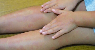 4歲女童染梅毒！醫師一查傻眼：阿嬤「用嘴餵食」害慘孫女