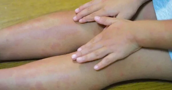 醫師提醒，梅毒不僅會透過性接觸傳播，如發現類似症狀，務必及早就醫治療。圖僅示意，與本文無關。（示意圖／photoAC）