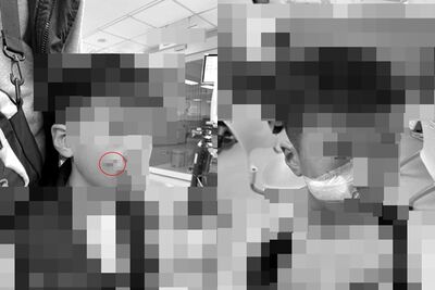 孩童玩「彈弓飛鏢」臉被割開！慘送醫縫針　家長心痛籲：提高警覺