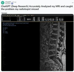 ChatGPT判讀MRI揪出醫師未察覺問題　人工智慧正改寫醫療現場