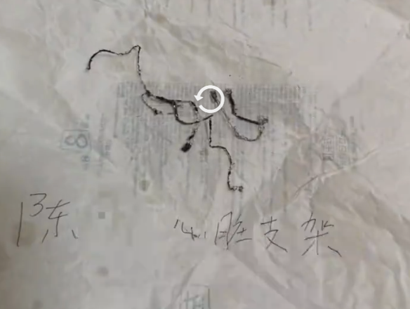 ▲陳先生的心臟支架。（圖／翻攝自微博）