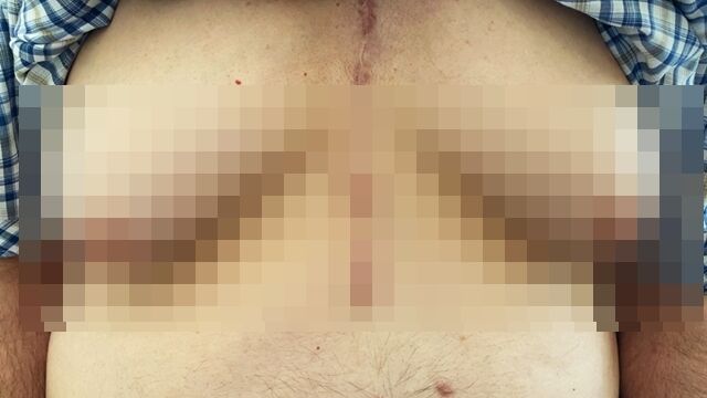 ▲▼76歲阿公「乳房發育了」！美研究揭原因　竟是這款藥。（圖／翻攝nejm.org）