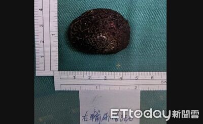 腰痠以為老了！醫驚見2顆「鳥蛋級結石」卡死輸尿管