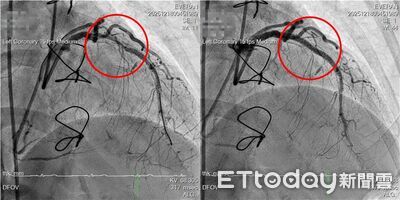 多次治療仍反覆狹窄　IVL震波碎石術助婦人打通血路