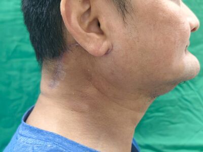 男「右臉+牙齦腫」竟是口腔癌　醫揭3警訊：2周未癒合快就醫