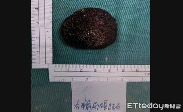 ▲台中醫院,泌尿科,結石,簡維弘。（圖／記者游瓊華攝）