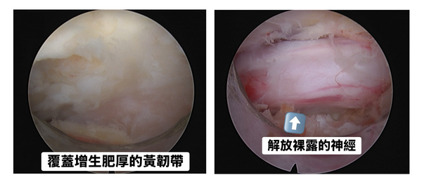 ▲六旬婦靠超微創手術隔天出院重獲新生