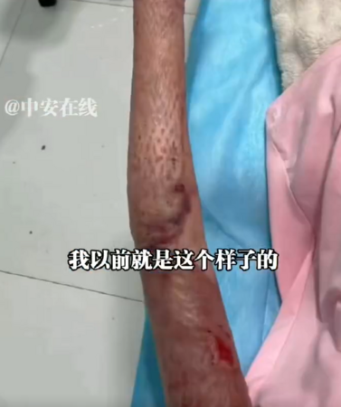 ▲女子全身70%燒傷。（圖／翻攝自微博，上同）