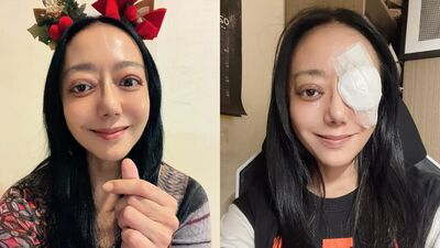 高慧君大小眼正面照曝光！　「剩最後一次手術」吐心聲