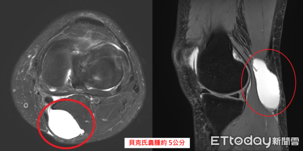 ▲▼      貝克氏囊腫       。（圖／中醫大新竹附醫提供）