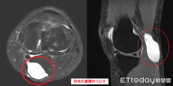 ▲▼      貝克氏囊腫       。（圖／中醫大新竹附醫提供）