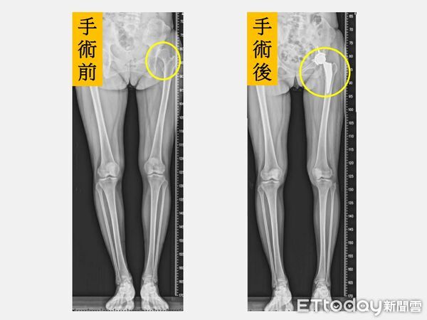 ▲黃贊文建議陳小姐進行「微創正前開髖關節置換手術」。（圖／記者游瓊華翻攝）