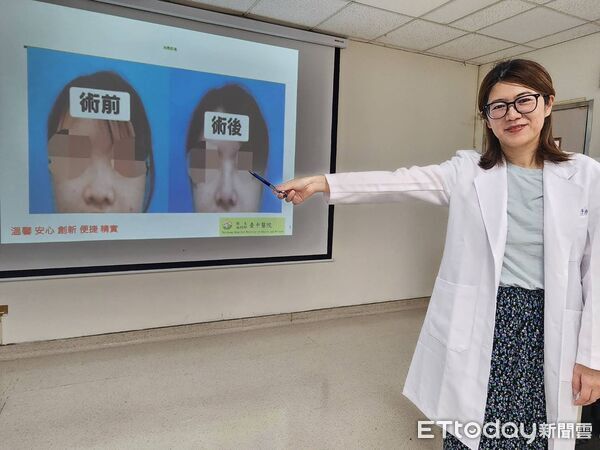 ▲醫師取約3公分自體肋軟骨進行鼻樑重建，兼顧支撐力與安全性。（圖／記者游瓊華翻攝）