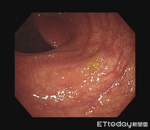 ▲▼大腸鋸齒狀腺瘤。（圖／葉人豪醫師授權提供，未經同意請勿任意翻攝）
