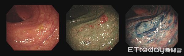 ▲▼大腸鋸齒狀腺瘤。（圖／葉人豪醫師授權提供，未經同意請勿任意翻攝）