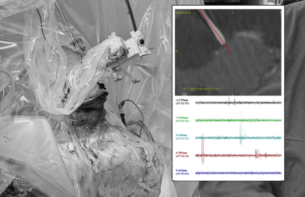 ▲▼臺灣首例「藥物難治型癲癇」最新型深腦刺激系統植入。（圖／台大醫院提供）