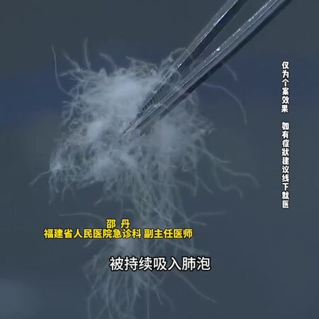 ▲▼陸男穿「破羽絨衣」12小時呼吸衰竭！　醫：警惕「羽絨肺」。（圖／翻攝微博）