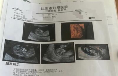 陸女子懷孕每次產檢就發現多一胎　醫驚是1／1500萬「同卵四胞胎」