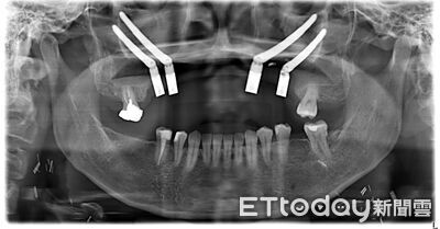 不菸不酒也中鏢！40歲女罹口腔癌　醫切上顎「再拔10顆牙」重建