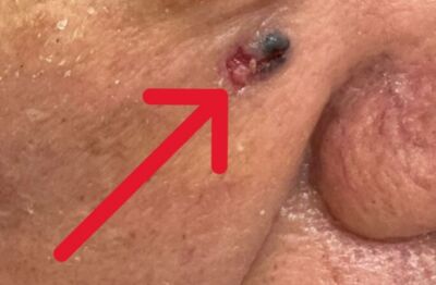 男臉上黑痣變大「竟是基底細胞癌」　醫揭最常出現4部位