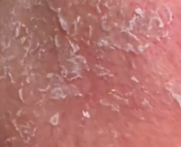 過「油」不及！　陸女早晚「以油護膚」竟致臉脫皮如炸雞鱗片