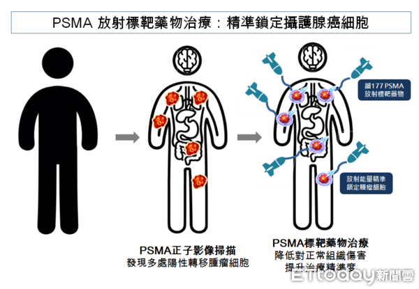 ▲▼     新型放療        。（圖／亞東醫院）