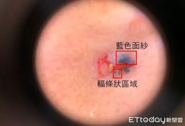 就醫做病理檢查才發現是「基底細胞癌」。（圖／醫師提供）