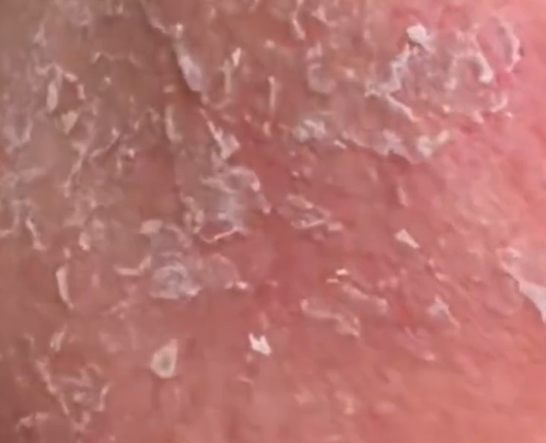 ▲林太太的臉瘋狂脫皮，整臉如炸雞鱗片。（示意圖／翻攝自微博）