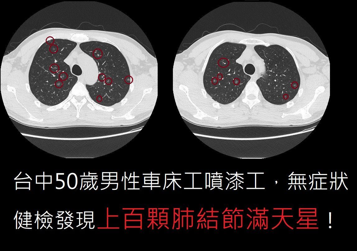 ▲沒有不舒服！台中50歲男健檢「破百顆肺結節」嚇壞了。（圖／翻攝自臉書／蘇一峰）