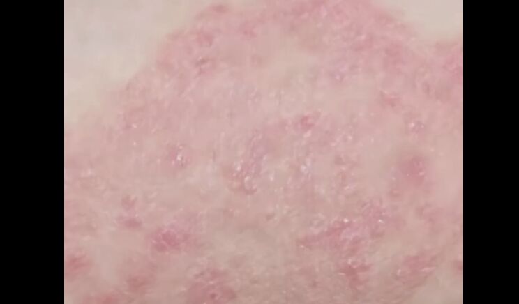 ▲陸7歲女童疑因家中衣服混洗，身上感染腳氣細菌長出紅斑。（圖／翻攝羊城晚報）