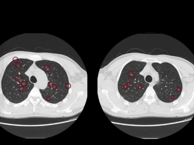 沒有不舒服！台中50歲男健檢「照出破百顆肺結節」　醫師也震驚