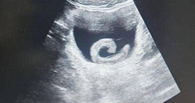 23歲男追求「特殊體驗」！竟將5cm活水蛭塞尿道　下秒痛到衝醫院