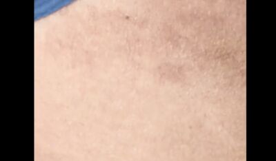 全家衣服混洗！陸女童身上長出紅疹還脫屑　醫判斷：爸爸香港腳傳染