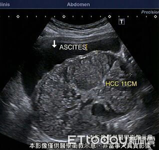 40歲男「以為只是脹氣」　醫一掃超音波…全場安靜了