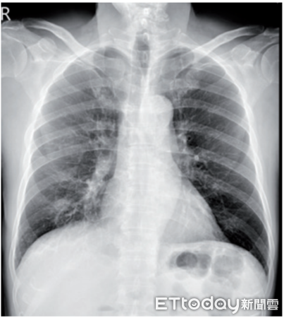 ▲▼      球黴菌影像       。（圖／中醫大附醫提供）