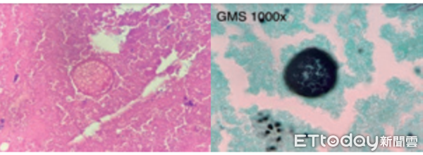 ▲▼      球黴菌影像       。（圖／中醫大附醫提供）