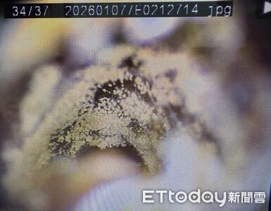 年輕妹喊好癢！兩耳炸出「毛茸茸一整片」醫看傻　壞習慣害發霉了